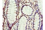 Immunohistochemistry of paraffin-embedded human colon cancer using CSB-PA005510ESR1HU at dilution 1:100