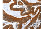 The image on the left is immunohistochemistry of paraffin-embedded Human colon cancer tissue using CSB-PA005512(ANAPC10 Antibody) at dilution 1/40, on the right is treated with fusion protein. (Original magnification: 