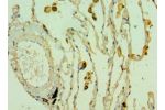 Immunohistochemistry of paraffin-embedded human lung cancer using CSB-PA005531ESR1HU at dilution 1:100
