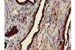 Immunohistochemistry of paraffin-embedded human prostate cancer using CSB-PA005552LA01HU at dilution of 1:100