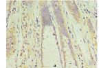 Immunohistochemistry of paraffin-embedded human colon cancer using CSB-PA005558ESR2HU at dilution 1:100