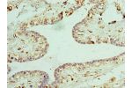 Immunohistochemistry of paraffin-embedded human breast cancer using CSB-PA005591DSR2HU at dilution 1:100