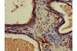 Immunohistochemistry of paraffin-embedded human prostate cancer using CSB-PA005657LA01HU at dilution of 1:100