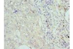 Immunohistochemistry of paraffin-embedded Human lung cancer using CSB-PA005703ESR2HU at dilution 1:100