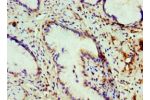 Immunohistochemistry of paraffin-embedded human cervical cancer using CSB-PA005711ESR1HU at dilution 1:100