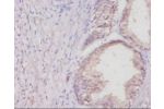 Immunohistochemistry of paraffin-embedded human colon cancer using CSB-PA005727YA01RA at dilution 1:20
