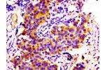 Immunohistochemistry of paraffin-embedded human bladder cancer using CSB-PA005752LA01HU at dilution of 1:100