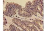 Immunohistochemistry of paraffin-embedded human endometrial cancer using CSB-PA005932EA01HU at dilution of 1:100