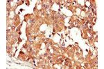 Immunohistochemistry of paraffin-embedded human breast cancer using CSB-PA005936LA01HU at dilution of 1:100