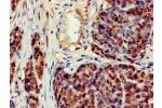 Immunohistochemistry of paraffin-embedded  human ovarian cancer using CSB-PA005945LA01HU at dilution of 1:100