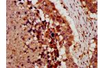 IHC image of CSB-PA005982LA01HU diluted at 1:300 and staining in paraffin-embedded human lung cancer performed on a Leica BondTM system. After dewaxing and hydration, antigen retrieval was mediated by high pressure in a citrate buffer (pH 6.0). Section wa