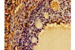 Immunohistochemistry of paraffin-embedded human ovarian cancer using CSB-PA006047LA01HU at dilution of 1:100