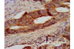 IHC image of CSB-PA006063LA01HU diluted at 1:300 and staining in paraffin-embedded human colon cancer performed on a Leica BondTM system. After dewaxing and hydration, antigen retrieval was mediated by high pressure in a citrate buffer (pH 6.0). Section w