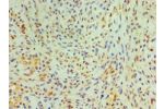 Immunohistochemistry of paraffin-embedded human breast cancer using CSB-PA006092ESR2HU at dilution 1:100
