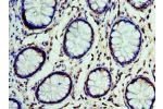Immunohistochemistry of paraffin-embedded human colon cancer using CSB-PA006095ESR2HU at dilution 1:100