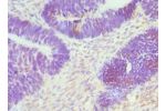 Immunohistochemistry of paraffin-embedded human ovarian cancer using CSB-PA006138DSR1HU at dilution 1:100
