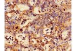 Immunohistochemistry of paraffin-embedded human liver cancer using CSB-PA006172LA01HU at dilution of 1:100