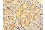 Immunohistochemistry of paraffin-embedded human gastric cancer using CSB-PA006188LA01HU at dilution of 1:100