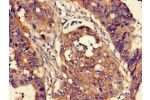 Immunohistochemistry of paraffin-embedded human colon cancer using CSB-PA006226LA01HU at dilution of 1:100