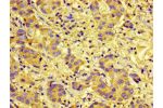 Immunohistochemistry of paraffin-embedded human liver cancer using CSB-PA006255LA01HU at dilution of 1:100