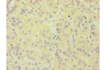 Immunohistochemistry of paraffin-embedded human liver cancer using CSB-PA006376ESR2HU at dilution 1:100