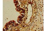 Immunohistochemistry of paraffin-embedded human colon cancer using CSB-PA006395LA01HU at dilution of 1:100