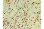 Immunohistochemistry of paraffin-embedded human breast cancer using CSB-PA006430ESR1HU at dilution 1:100