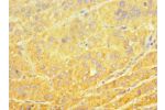 Immunohistochemistry of paraffin-embedded human liver cancer using CSB-PA006446ESR1HU at dilution 1:100