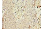 Immunohistochemistry of paraffin-embedded human lung cancer using CSB-PA006448ESR1HU at dilution 1:100