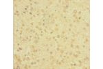 Immunohistochemistry of paraffin-embedded human glioma cancer using CSB-PA006519HA01HU at dilution 1:100