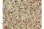 Immunohistochemistry of paraffin-embedded human glioma cancer using CSB-PA006547LA01HU at dilution of 1:100