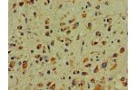 Immunohistochemistry of paraffin-embedded human glioma cancer using CSB-PA006548LA01HU at dilution of 1:100