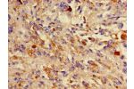 Immunohistochemistry of paraffin-embedded human melanoma cancer using CSB-PA006562LA01HU at dilution of 1:100