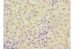 Immunohistochemistry of paraffin-embedded human liver cancer using CSB-PA006563ESR2HU at dilution 1:100