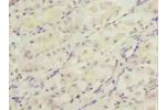 Immunohistochemistry of paraffin-embedded human gastric cancer using CSB-PA006589LA01HU at dilution of 1:100