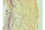 Immunohistochemistry of paraffin-embedded human cervical cancer using CSB-PA006621DSR2HU at dilution 1:100