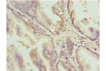 Immunohistochemistry of paraffin-embedded human prostate cancer using CSB-PA006648ESR2HU at dilution 1:100