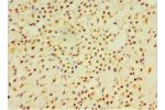 Immunohistochemistry of paraffin-embedded human breast cancer using CSB-PA006705ESR1HU at dilution 1:100