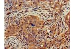 Immunohistochemistry of paraffin-embedded human pancreatic cancer using CSB-PA006817LA01HU at dilution of 1:100