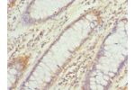 Immunohistochemistry of paraffin-embedded human rectal cancer using CSB-PA006845ESR2HU at dilution 1:100