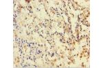 Immunohistochemistry of paraffin-embedded human lung cancer using CSB-PA006847HA01HU at dilution 1:100