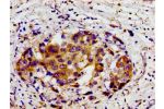 Immunohistochemistry of paraffin-embedded human breast cancer using CSB-PA006852LA01HU at dilution of 1:100