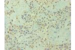 Immunohistochemistry of paraffin-embedded human breast cancer using CSB-PA006907ESR2HU at dilution 1:100