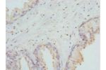 Immunohistochemistry of paraffin-embedded human prostate cancer using CSB-PA006953DSR2HU at dilution 1:100