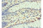 Immunohistochemistry of paraffin-embedded human colon cancer using CSB-PA006954ESR2HU at dilution 1:100