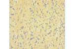 Immunohistochemistry of paraffin-embedded human glioma cancer using CSB-PA007062LA01HU at dilution 1:100