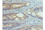 Immunohistochemistry of paraffin-embedded CSB-PA007082HA01HU using human colon cancer at dilution 1:100