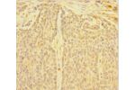 Immunohistochemistry of paraffin-embedded human ovarian cancer using CSB-PA007089LA01HU at dilution 1:100