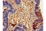 Immunohistochemistry of paraffin-embedded human ovarian cancer using CSB-PA007172LA01HU at dilution of 1:100