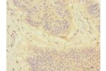 Immunohistochemistry of paraffin-embedded human colon cancer using CSB-PA007189ESR1HU at dilution 1:100